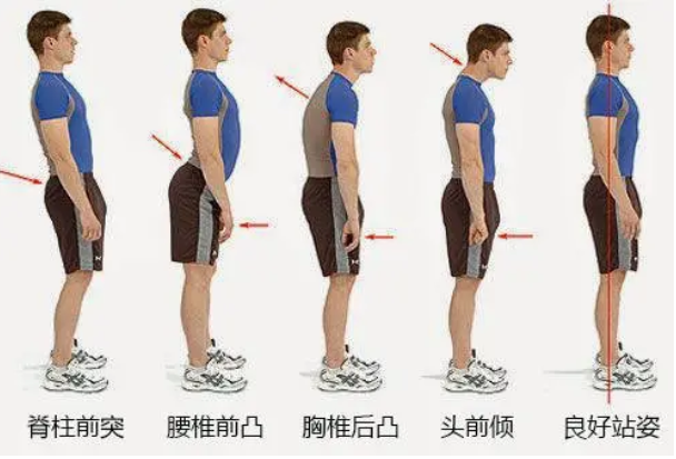 脊柱側(cè)彎人體展現(xiàn)的形態(tài)
